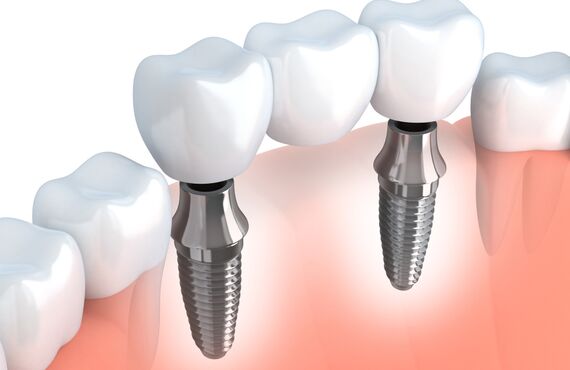 美容と身体づくりを踏まえたインプラントの診療を広島市内でご案内中です
